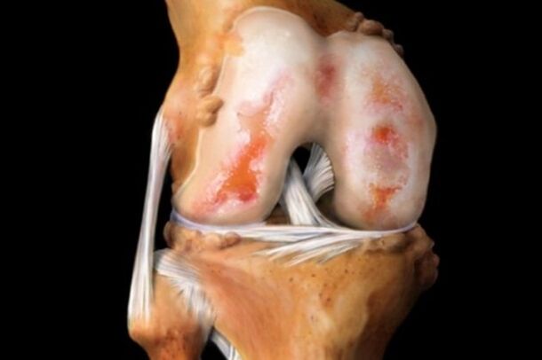 Belauneko artikulazioa suntsitzea artrosiaren ondorioz - muskulu-eskeletiko sistemaren ohiko patologia