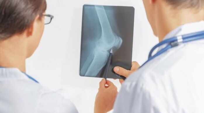 Belauneko artrosiaren beharrezko diagnostikoa egin ondoren, medikuek tratamendu konplexua agintzen dute