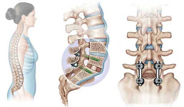 Osteokondrosiaren fase aurreratuan inplanteekin desplazatutako ornoen finkapena