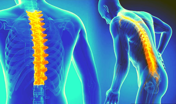 Bizkarrezurraren osteokondrosia