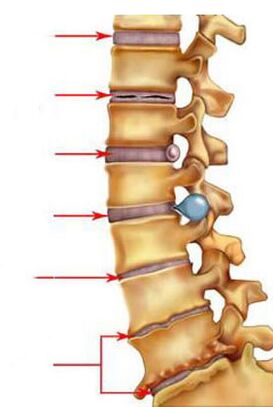 Nola garatzen da osteokondrosia