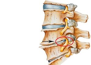 zerbikaleko osteokondrosiaren arrazoiak